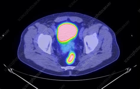 Colon Cancer Ct And Pet Scans Stock Image M1340705 Science