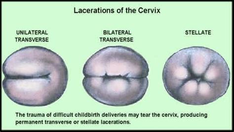 Cx Lacerations Cervical Cancer Cervix Cancer