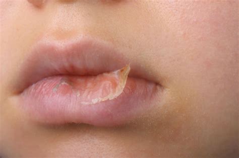 Dermatitis On Lips Symptoms Lipstutorial Org