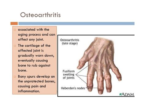 What Is The Difference Between Gout And Rheumatoid Arthritis