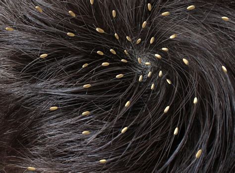 Head Lice Causes Symptoms Prevention And Treatments