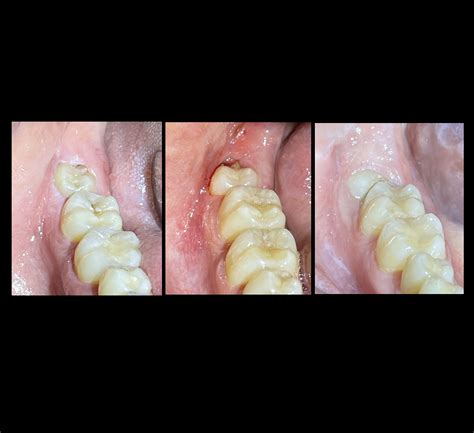 periodontal disease and wisdom teeth david c stahr dds oral surgery — stahr oral surgery