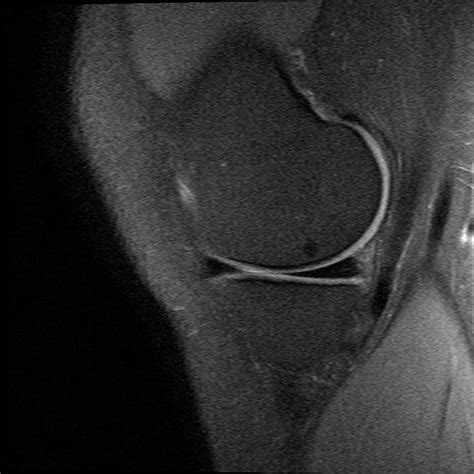 Informationen zur kernspintomographie vom knie. Mrt Bilder - Meniskusriss? (Knie, Orthopädie, Chirurgie)