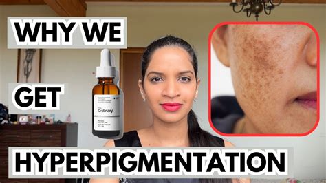 How To Fade Hyperpigmentation On Face Why Do We Get Hyperpigmentation