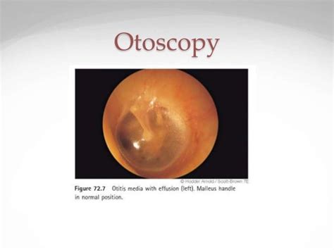 Ome Otitis Media With Effusion In Children
