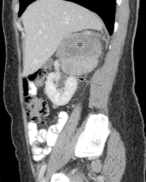 Retroperitoneal Leiomyosarcoma From The Radiologic Pathology Archives