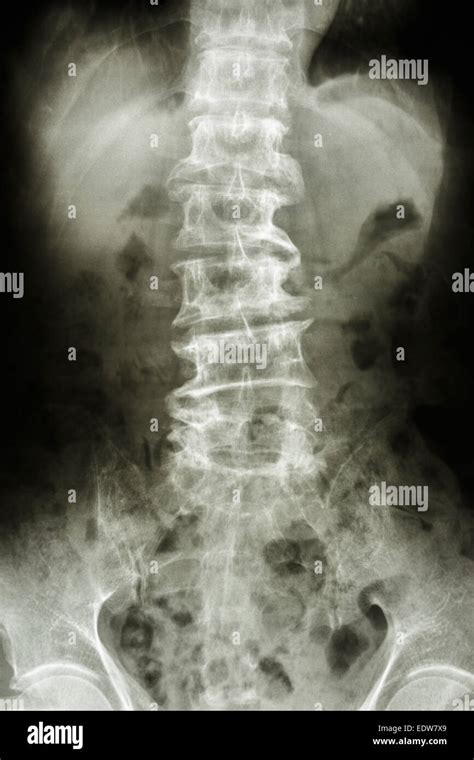 Film X Ray Show Bent Lumbar Spine And Spurs Of Old People Spondylosis
