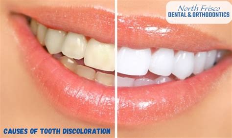 Tooth Discoloration Probable Causes And Treatments