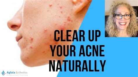 how to clear up acne naturally youtube