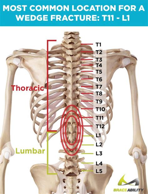 2 fractures du rachis fréquence : Spinal Wedge Compression Fractures: Daring Sports That Put ...
