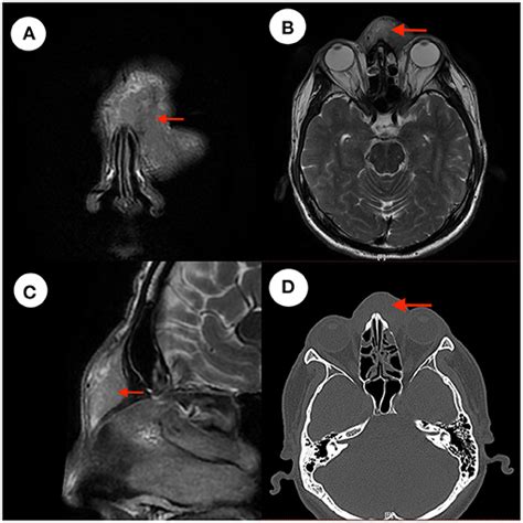 Frontiers Case Report A Rare Case Of Nasal Forehead Mass In Kimuras