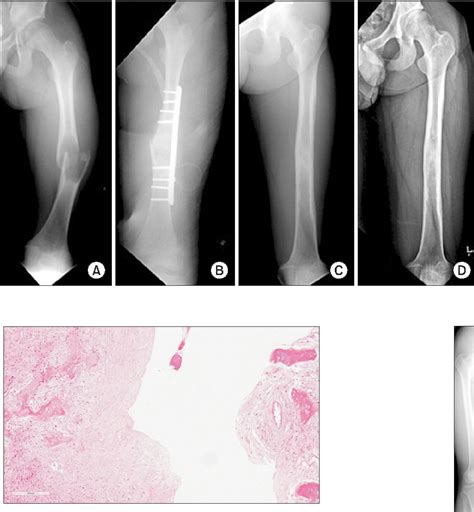 Figure 2 From Recurrence Of A Unicameral Bone Cyst In The Femoral