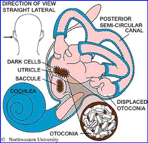The eustachian tube consists of. Anatomy of the left inner ear showing displaced otoconia ...