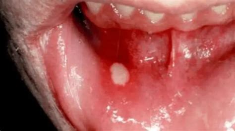 Aphthous Ulcers Symptoms Causes And Treatment Healthtian
