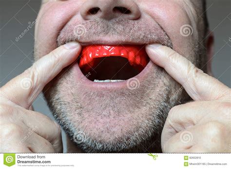 Man Placing A Bite Plate In His Mouth To Protect His Teeth At Night