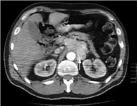 Abdominal Computed Tomography Showing Lobulated Mass In The Region Of