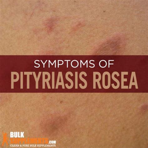 Pityriasis Rosea Symptoms Causes Treatment