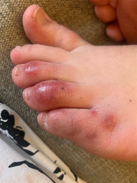 Covid Toes Reported In Some Patients With The Coronavirus