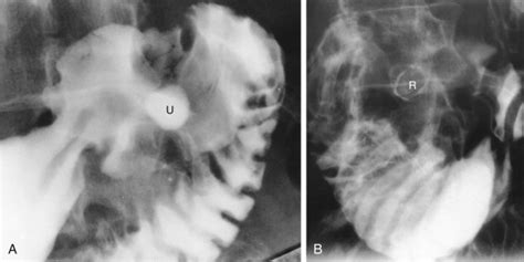 Barium Studies Single And Double Contrast Radiology Key