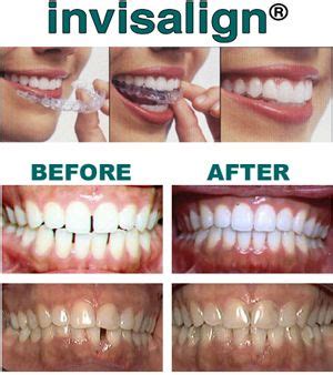 See full list on drarocha.com How Much Does Invisalign Cost? - in 2018