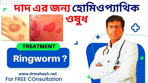 Ringworm Homeopathic Medicine For Ringworm Fungal Infection দাদ এর