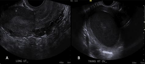 2d Transvaginal Pelvic Ultrasonography A Left Unicornuate Uterus B