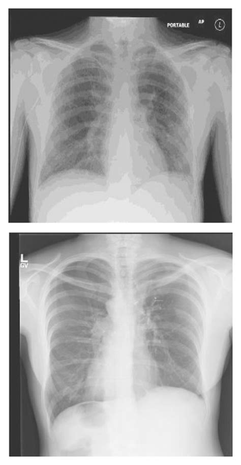 Representation Of Chests X Ray In Covid 19 Patients A No Findings