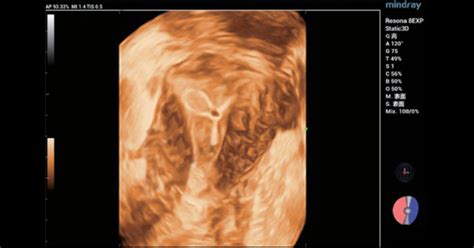 Ultrasound Journal 4 Ultrasound Assessment Of Intrauterine Device