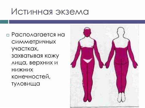Экзема истинная диета Экзема. Факторы, вызывающие экзему - презентация онлайн Экзема. Факторы, вызывающие экзему - презентация онлайн Экзема истинная диета