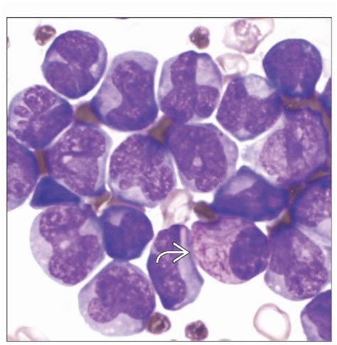 Acute Promyelocytic Leukemia With T1517q22q21 Pml Rara And