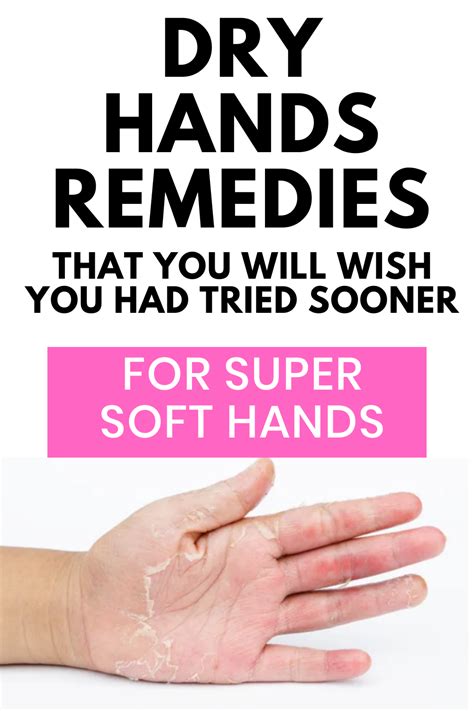 Dry Hand Remedies Artofit