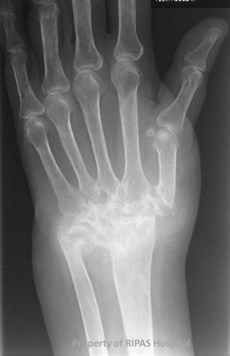 Rheumatoid arthritis manifests as a symmetrical arthritis, most commonly affecting the hands. Rheumatoid arthritis end stage