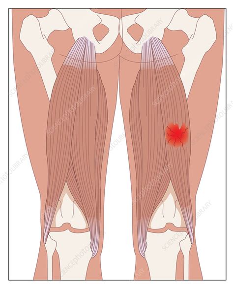 Hamstring Muscle Injury Artwork Stock Image C0090514 Science