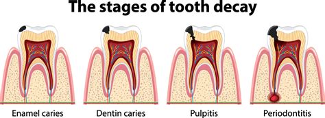 6 Signs Of Dental Cavities — Woodsprings Dentistry