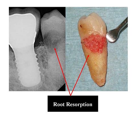 Resorption Ask A Dentist
