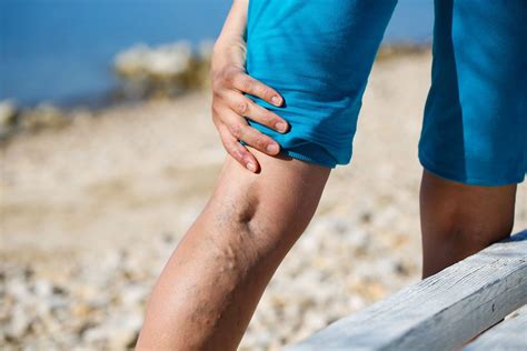 Varicose Veins Faq All Your Questions Answered