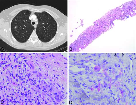 Diagnosis Of Pulmonary Langerhans Cell Histiocytosis By Ct Guided Core