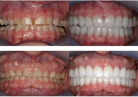 Worn Or Chipped Teeth Explained And Treated At Smile Columbia