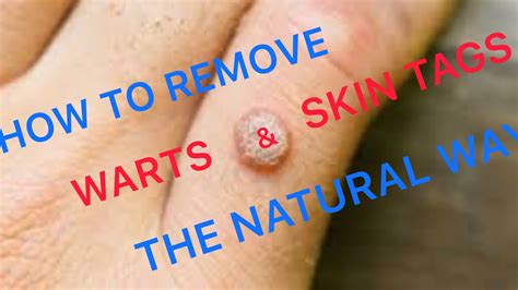 “how To Remove Warts And Skin Tags The Natural Way” Youtube