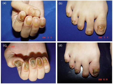 Severe 20 Nail Psoriasis Successfully Treated By Low Dose Methotrexate