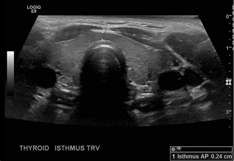 Thyroid Ultrasound Protocol Sonographic Tendencies