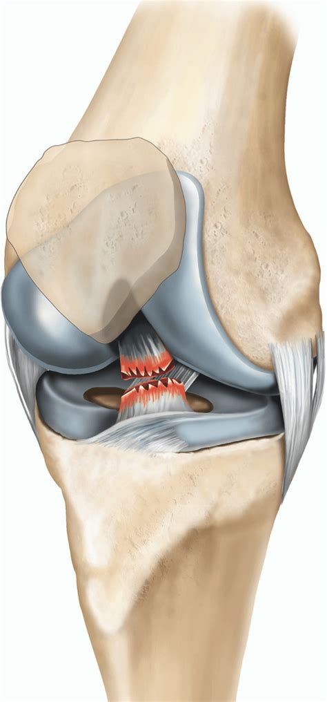 Anterior Cruciate Ligament Acl Reconstruction Surgery Most Advanced