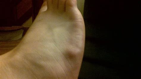 It may appear similar to a small tumor, but it is not cancerous and is often the result of foot strain or injury. Is This A Cyst On My Foot? How Do I Treat It? - Cherrywood ...