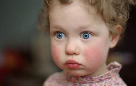 Slapped Cheek Syndrome Pictures Symptoms Treatment Prevention Images
