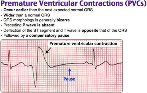 Premature Atrial Contraction Definition Definitiont