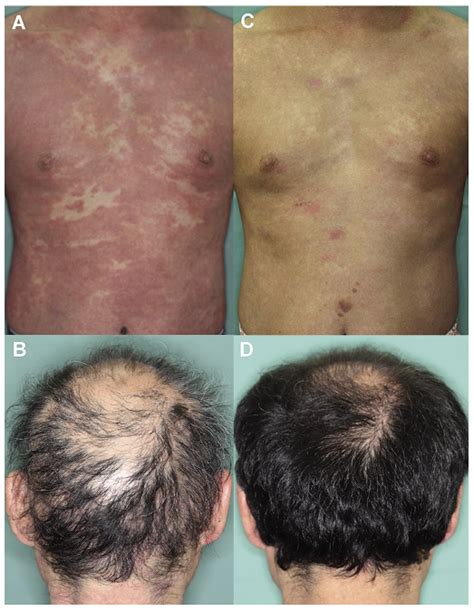 Dupilumab Improved Alopecia Areata In A Patient With Atopic Dermatitis