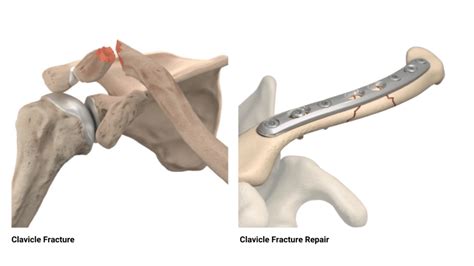 Clavicle Fractures Edward S Chang Md