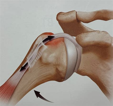 Biceps Tenodesis Shoulder Injuries Dr Christopher Ahmad