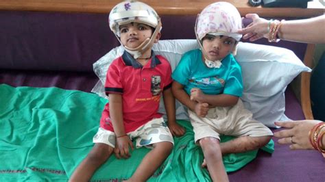 Separated Conjoined Twins Jaga And Kalia To Be Treated At The Neurosurgery Ward At Scb Cuttack