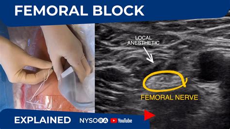 Ultrasound Guided Femoral Nerve Block Regional Anesthesia Crash
